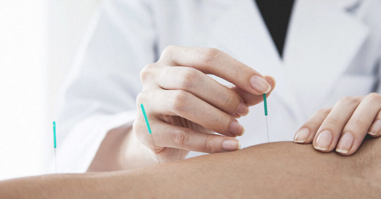 Dry Needling
