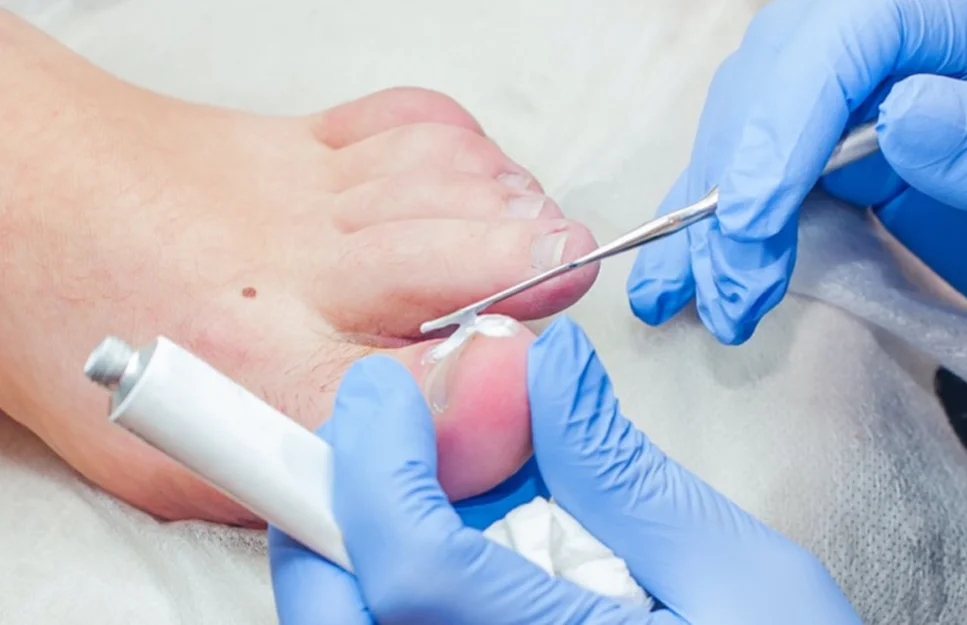 Ingrown Toenails and Nail Surgery